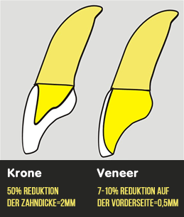 Keramikkronen und Veneers