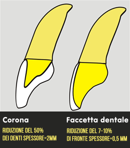 La differenza tra una faccetta dentale in ceramica e una corona